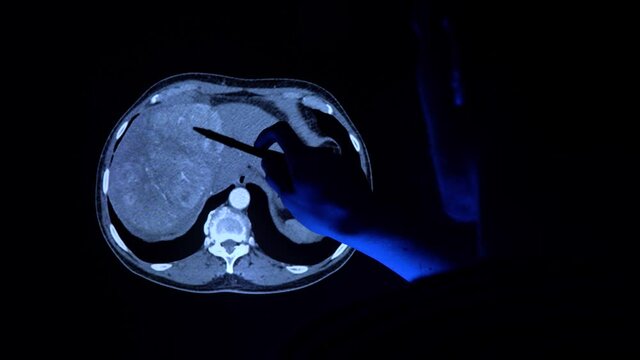 Doctor with a pen checking a tomography scan of a liver with cancer tumor. Medical diagnostic of the liver to prevent liver cancer. X-ray. Tomography MRI, CT examining in 4k video.