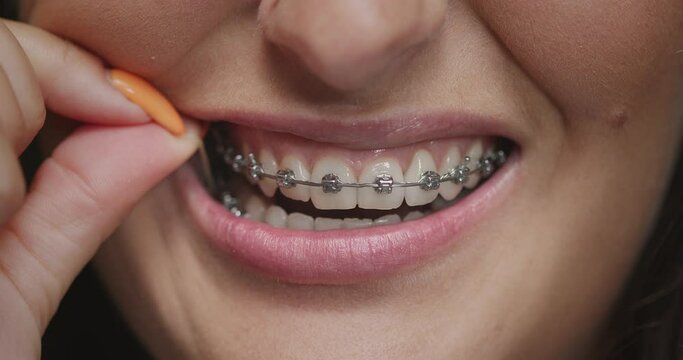 Teeth alignment by braces and elastics. Close-up female mouth. Orthodontic treatment. Correction of overbite