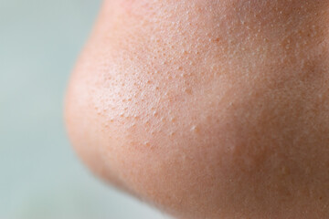 Macro close up in selective focus of a chin with large amount of blackheads and dilated pores....