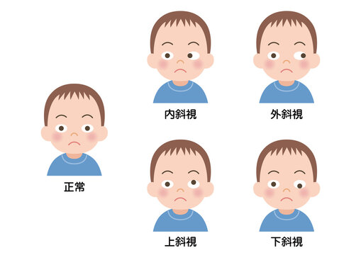 「寄り目」の画像 - 5,254 件の Stock 写真、ベクターおよびビデオ | Adobe Stock