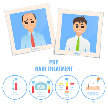 Photographs of a man before and after PRP treatment. Platelet rich plasma procedure stages. Male hair loss design template. Alopecia medical concept. Vector illustration.