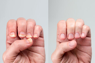 Before and after successful treatment for a onychomycosis or fungal nail infection on damaged nails...