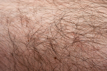 メンズ　脱毛　beforeイメージ　脚のアップ