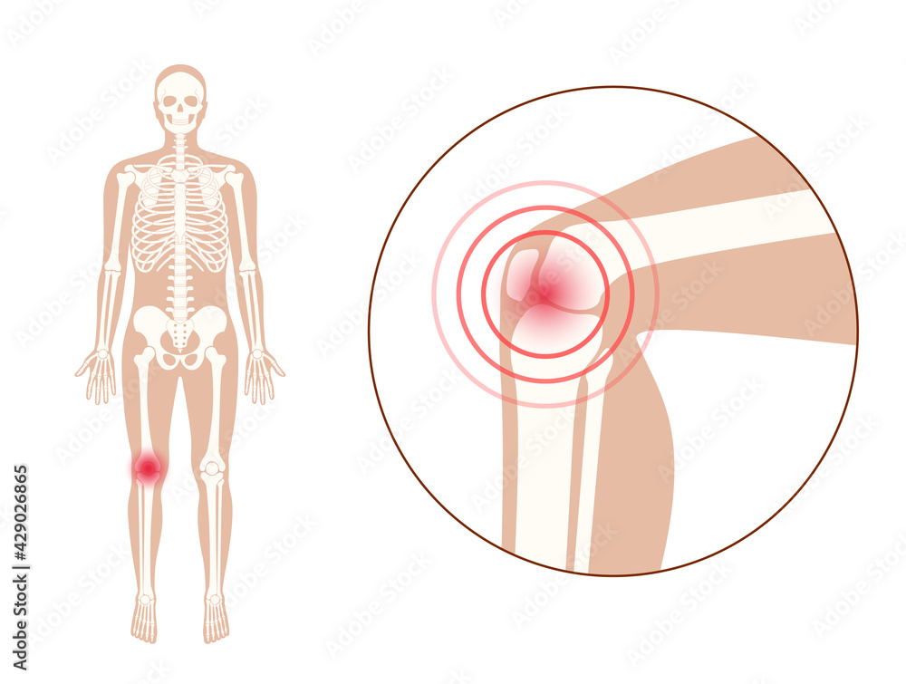 Poster pain in knee joint