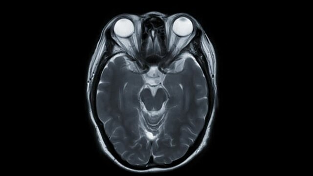 MRI Brain Axial T2W  technique for detect stroke disease.