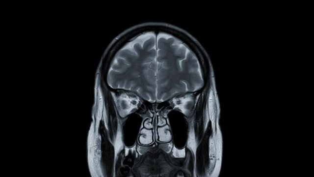 MRI Brain Coronal T2W  technique for detect stroke disease.