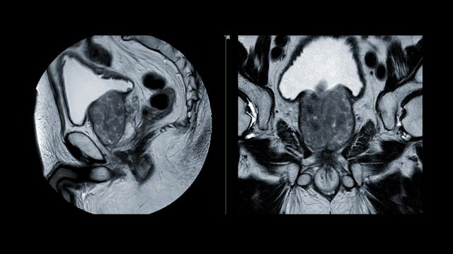  MRI prostate gland Sagittal T2W View for diagnosis prostate cancer cell in aged men.
