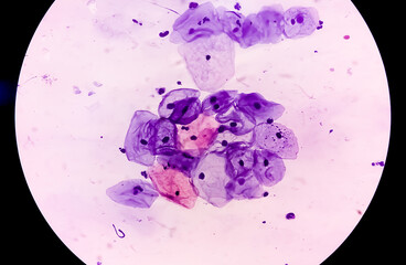 Microscopic view of human cervix cells. Squamous epithelial cells. Pap smear. pap's. Squamous cell...