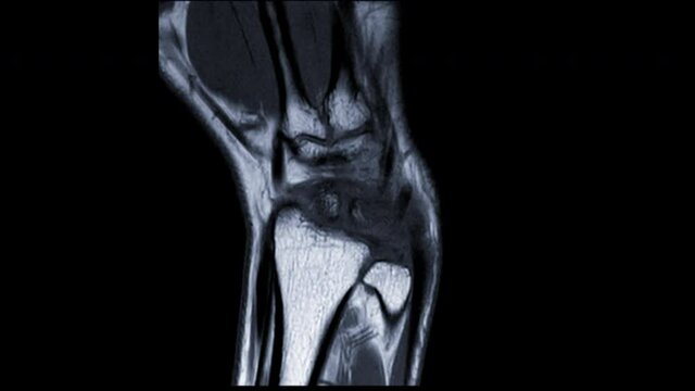 MRI wrist joint coronal T1W  For diagnosis  rheumatoid arthritis.