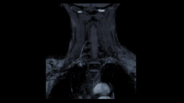 MRA corotid artery technique Time-of-Flight (TOF) showing common carotid artery.