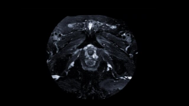  MRI prostate gland for diagnosis prostate cancer cell in aged men.