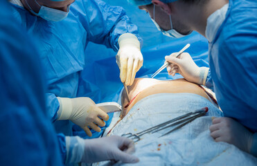 Breast augmentation under the guidance surgeons team in surgical operating room.