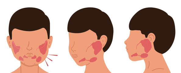 Obraz premium Person with sick and healthy salivary glands. Vector illustration of sialolithiasis.