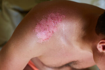 Fototapeta premium Severe sunburn on the man's shoulder. Ulcers and reddened, itchy skin after sunburn