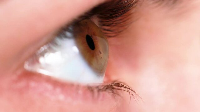 Macro eye video. Keratoconus - eye disease, thinning of the cornea in the form of a cone. The cornea plastic