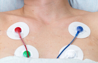 Holter monitor electrodes on the chest close up.