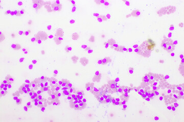 Fototapeta na wymiar Picture of acute lymphocytic leukemia or ALL cells in blood smear, analyze by microscope, 400x