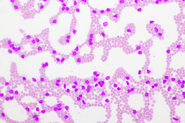 Picture of acute lymphocytic leukemia or ALL cells in blood smear, analyze by microscope, 400x