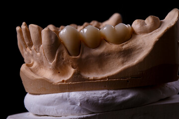 Fototapeta na wymiar Mold of teeth. Gypsum model plaster of teeth. Stomatologic plaster cast, molds of human jaws and teeth on black background. Dentistry and orthodontics concept