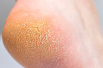 Close up of cracks on the heels. A persons heel with dry skin and cracks