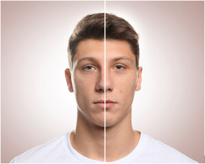 Teen guy with acne problem before and after treatment on light background, collage