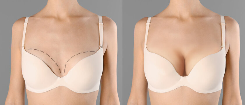 Collage with photos of young woman before and after breast size correction on grey background, closeup. Banner design