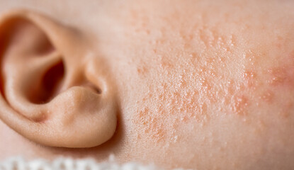 dermatitis allergic skin rashes on baby cheek close-up view