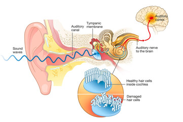 Tinnitus. Damaged hair cells inside cochlea - obrazy, fototapety, plakaty