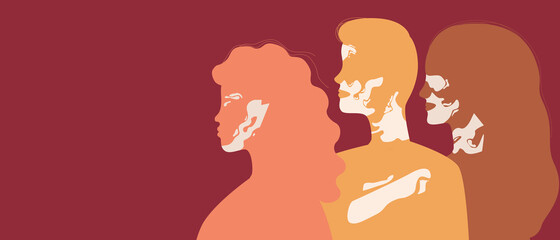 People with vitiligo isolated as copy space template, color vector stock illustration with men and women with autoimmune depigmentation