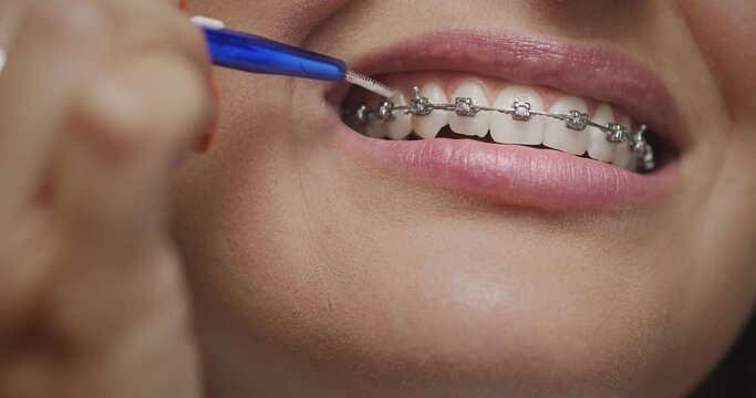 Teeth, braces brushing. Close up female cleaning interdental by orthodontic toothbrush. Dental hygiene, dentistry
