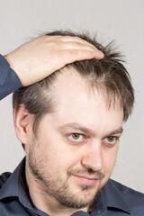 The man shows a high forehead with receding hairline. Baldness in men, hair care.