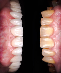 Perfect smile before and after veneers bleach of zircon arch ceramic prothesis Implants crowns....