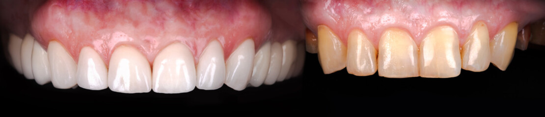 Perfect smile before and after veneers bleach of zircon arch ceramic prothesis Implants crowns....