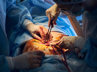 Close up of medical team performing abdominoplasty surgery in operating room. Plastic surgeon and assistant doing abdominal plastic surgery in hospital. Concept of tummy tuck and aesthetic surgery.