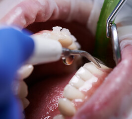 Obraz premium Close up of orthodontist using dental tools while cleaning teeth of patient. Woman with cheek retractor in mouth and braces on teeth receiving dental treatment. Concept of professional dental hygiene