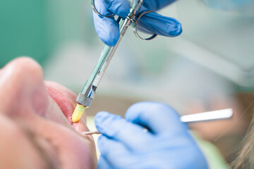 Dentist injects anesthesia syringe of the diseased teeth for the patient. Caries treatment.