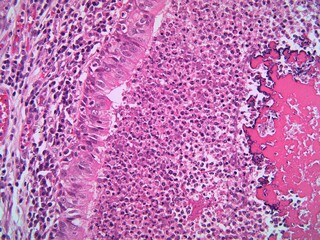 A lung bronchiole lined by ciliated epithelium and filled with massive acute inflammation and...