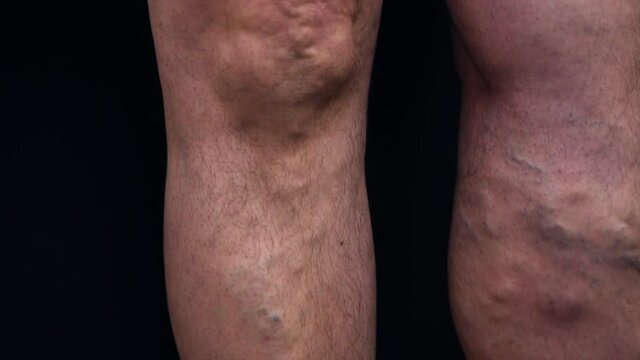 Twisting veins curving down of unrecognizable senior knee detailed. CLOSE-UP