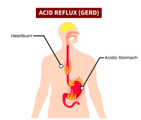 GERD, Acid Reflux Human stomach esophagus on fire gastroesophageal reflux disease, Heartburn, chronic Acidity, Gastric disease, stomach problem. Feeling pain bloating abdomen illustration