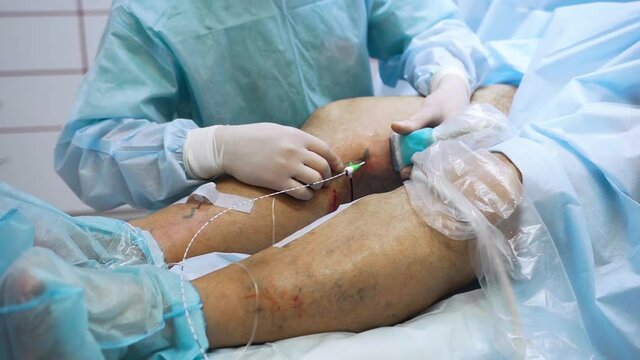 Doctor is performing medical procedure. Endovasal (endovenous) laser coagulation (obliteration) is used to eliminate varicose veins. Insertion of laser with luminous tip directly into vein.