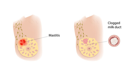 Woman breast. Mastitis and Clogged milk duct. Comparison. Medical vector illustration.