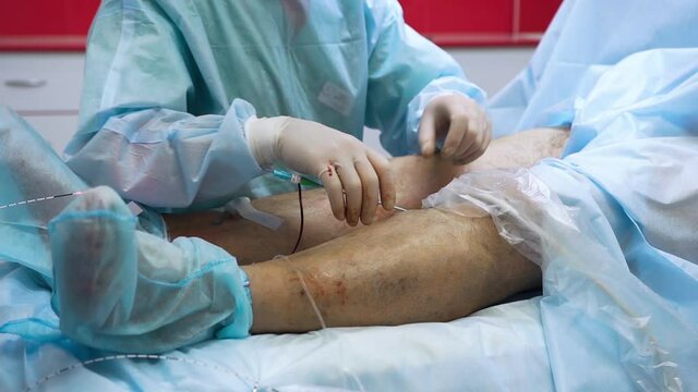 Doctor is performing medical procedure. Endovasal (endovenous) laser coagulation (obliteration) is used to eliminate varicose veins. Insertion of laser with luminous tip directly into vein.