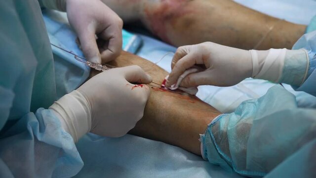 A phlebologist surgeon performs surgery on the legs of a patient with varicose veins with the help of a modern innovative manipulation method - laser ablation. The nurse wipes blood with gauze napkins