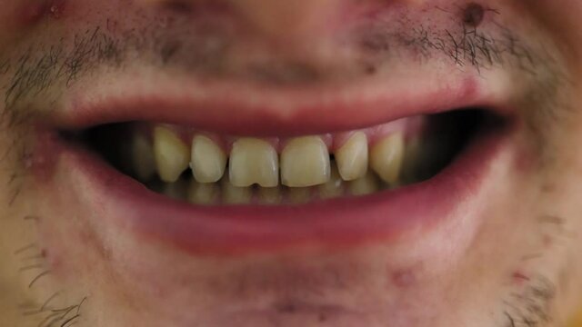 Bad tooth patient. Teeth with dental problems and bad, unhealthy smile. Oral healthcare concept.
