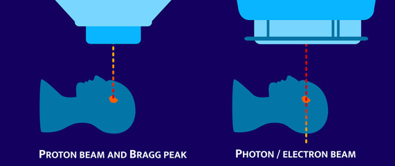 Bragg peak - comparing a proton beam and an electron beam in radiotherapy for cancer.  A patient in a linac / cobalt machine and a proton therapy machine, vector flat illustration.  - obrazy, fototapety, plakaty
