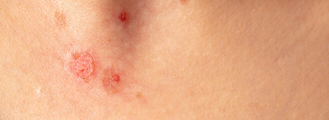 Burn wound on human skin.