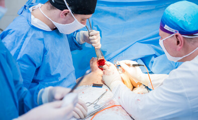 Breast augmentation under the guidance surgeons team in surgical operating room.