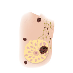 Woman breast. Cancer T4, metastasis. Medical vector illustration.