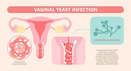 Douche vagina odor clean blood flora ectopic yeast bacterial Pelvic genitals swelling pain sex hygiene system microbes allergic cycle health problem tract prevent mucus Cervical cervix itching cancer