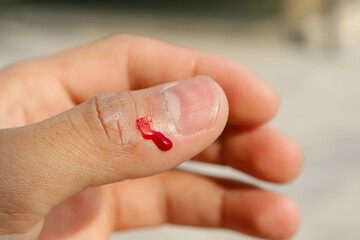 Bleeding from a thumb injury 